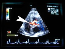 Ventrikelseptum-Defekt (Herzscheidewanddefekt, Farb-Doppler) Ventrikelseptum-Defekt (Herzscheidewanddefekt, Farb-Doppler)