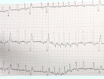 EKG Hund (Rhythmusstörungen, VES) EKG Hund (Rhythmusstörungen, VES)